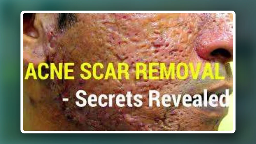 How To Treat And Get Rid Of Acne Scars- Acne Scar Prevention