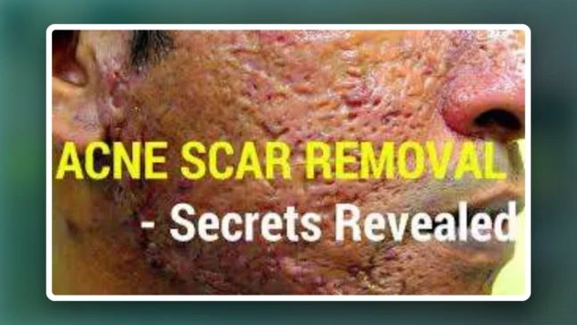 Read more about the article How To Treat And Get Rid Of Acne Scars- Acne Scar Prevention
