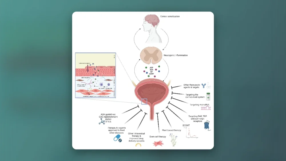 Dimethylsulfoxide for Interstitial Cystitis Review